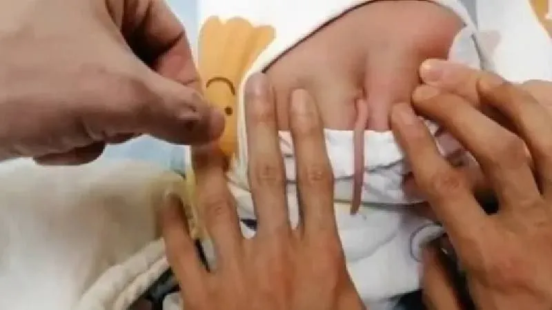 Çin’de Bir Bebek Kuyrukla Doğdu