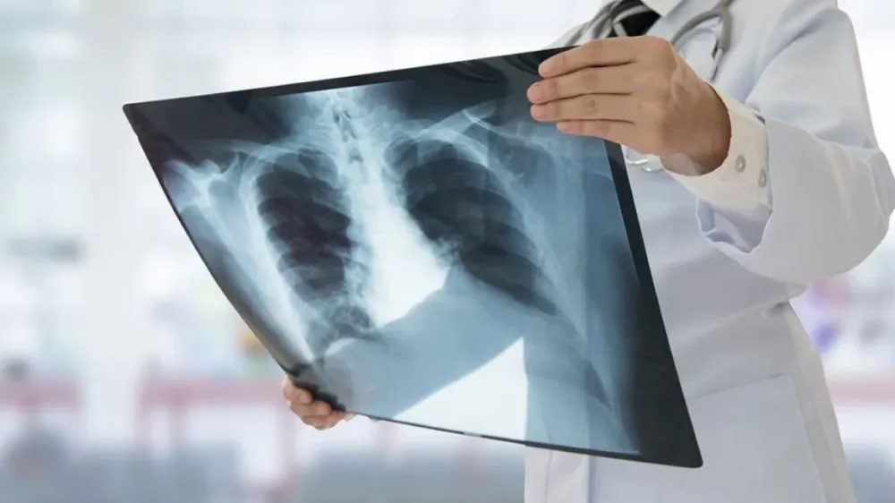 Kanserle savaş haftasında dikkat çeken rapor: Erkeklerde akciğer kadınlarda meme ilk sırada