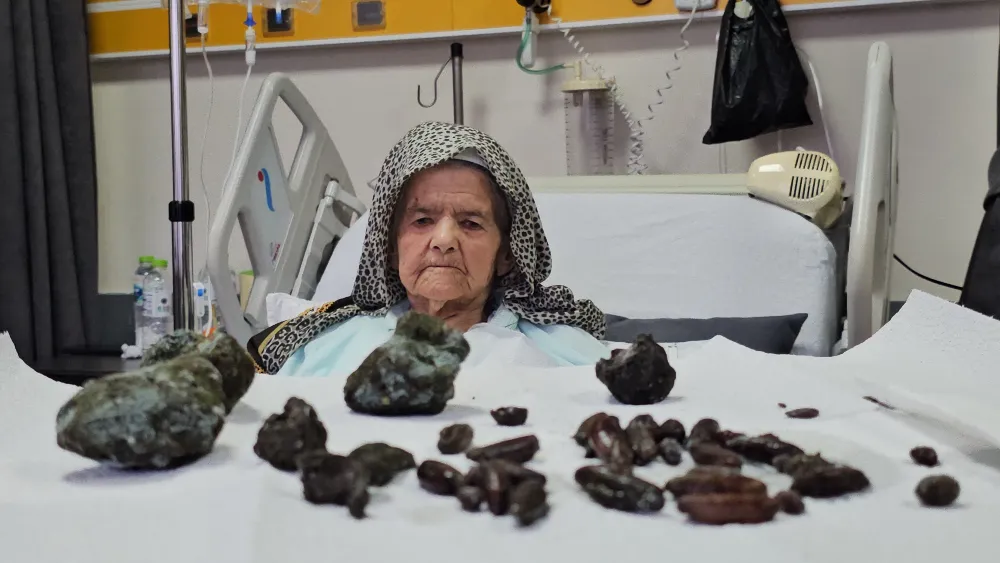 92 YAŞINDAKİ KADININ MİDESİNDEN ÇIKANLAR ŞOK ETTİ